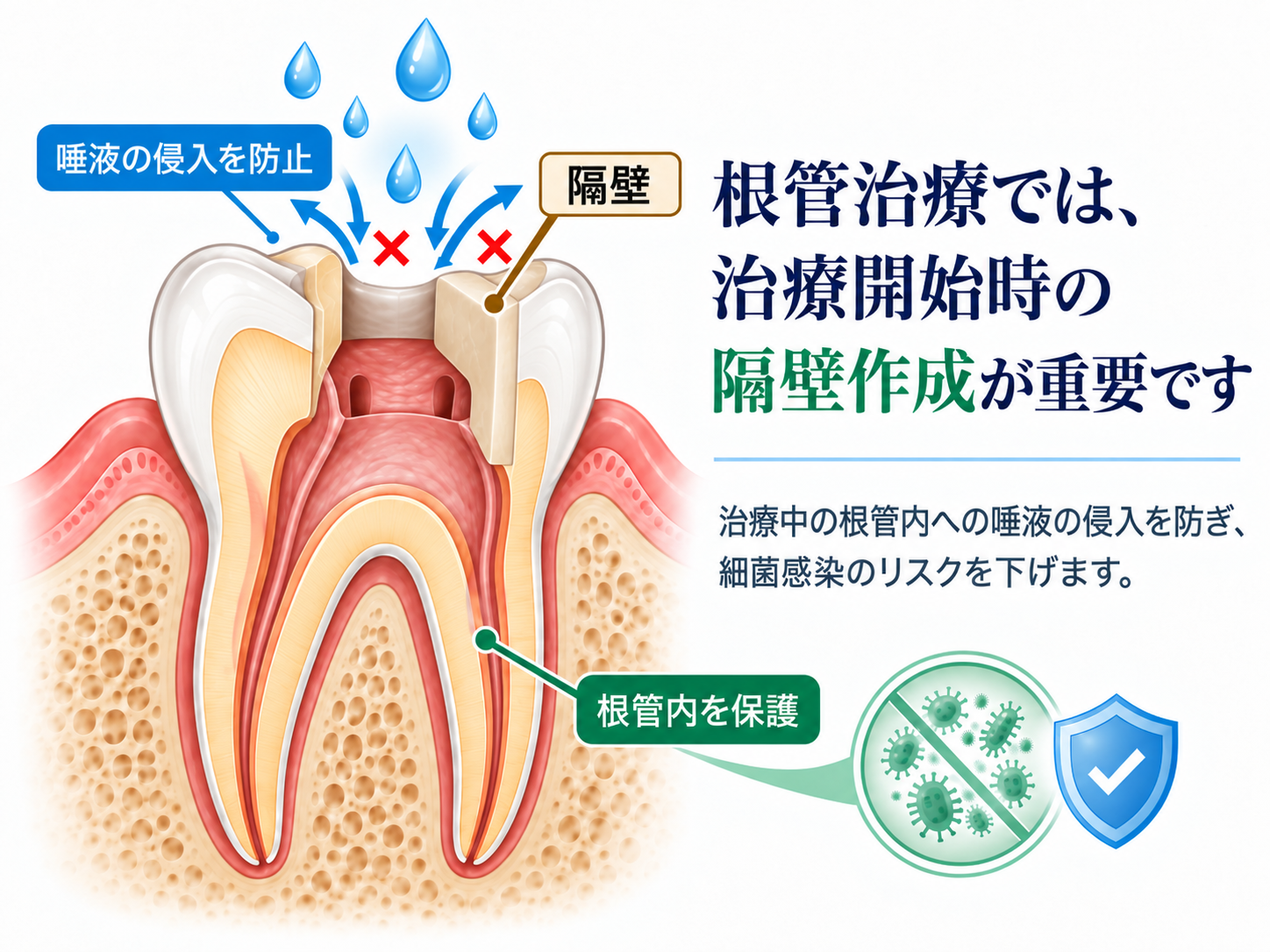 根管治療における隔壁作成と唾液侵入防止のイラスト
